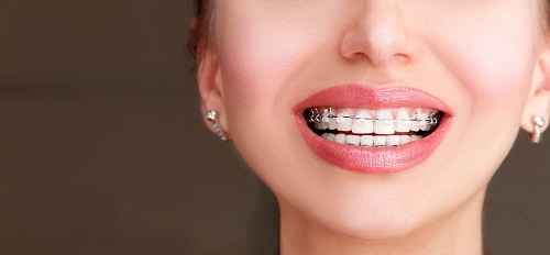 有牙周病可以箍牙嗎?深圳牙齒矯正價目表